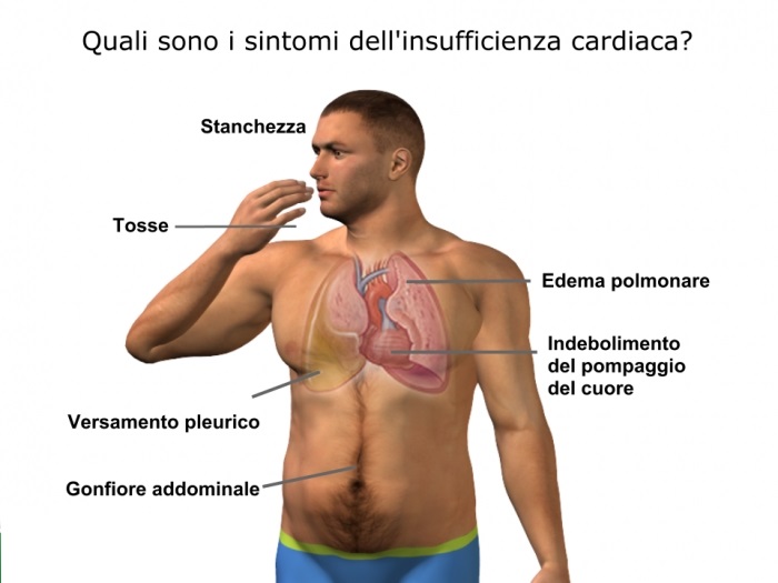 INFARTO: TUTTI I SINTOMI CHE NON TI ASPETTI - VIDEO - 22/07/2015