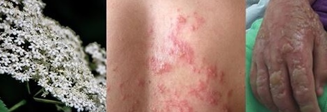 ATTENZIONE ALLA PIANTA VELENOSA NEI PARCHI: CINQUE BAMBINI GIA' RIMASTI USTIONATI - 23/05/2016