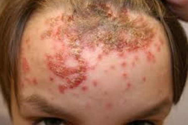 ALLARME SULLE SPIAGGE ITALIANE: TUTTI A RISCHIO IMPETIGINE - ECCO COME SI PRENDE - 14/06/2016