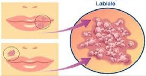 HERPES LABIALE, RIMEDI NATURALI PER EVITARE LA COMPARSA SOPRATTUTTO AL CAMBIO DI STAGIONE - 03/05/2015