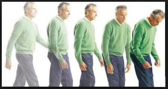 PARKINSON: ECCO I DIECI SINTOMI CHE LO SEGNALANO CON 10 ANNI DI ANTICIPO, MA CHE TUTTI TRASCURANO - 02/11/2016