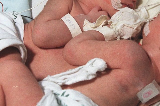 NASCONO I GEMELLI ''PARASSITI'': LE IMMAGINI CHE VI LASCERANNO SENZA PAROLE - 17/11/2016