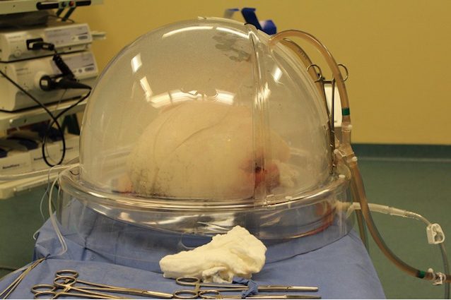 RIGENERATO E TRAPIANTATO: ECCO COME I MEDICI ITALIANI HANNO RECUPERATO UN POLMONE MALATO - 10/12/2016