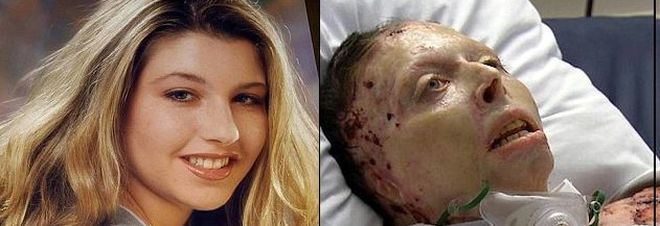 LITIGA CON IL FIDANZATO E LUI LE DA' FUOCO: ''MI GUARDAVA MENTRE BRUCIAVO VIVA'' - 16/12/2016