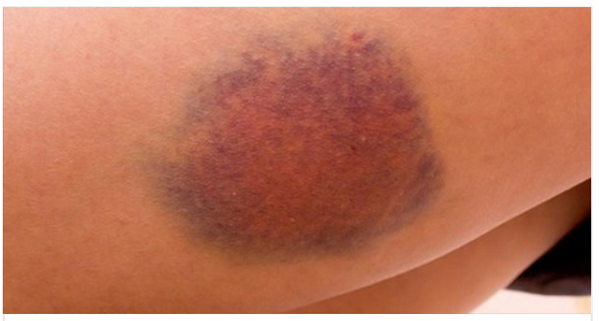 10 SINTOMI DEL CANCRO CHE LA MAGGIOR PARTE DELLE PERSONE IGNORA - 17/12/2016