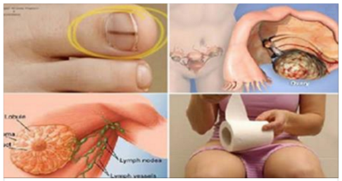 ECCO I SEGNALI DEL CANCRO PIU' COMUNI CHE LE DONNE SOTTOVALUTANO: FATE MOLTA ATTENZIONE - 03/04/2017