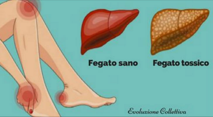 16 SINTOMI CHE INDICANO FEGATO PIGRO E SOVRACCARICO DI TOSSINE CHE TI STANNO FACENDO INGRASSARE - 18/04/2017