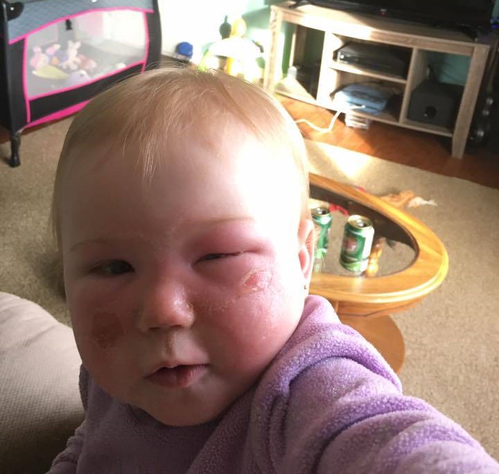 ''MIA FIGLIA HA UN'USTIONE DI SECONDO GRADO A CAUSA DI UNA CREMA SOLARE'' - 24/05/2017