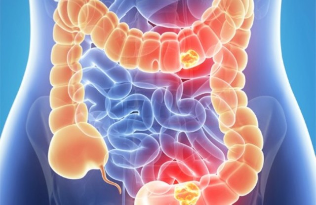 PURIFICA IL COLON E PERDE 8 KG. ECCO LA RICETTA DEL FRULLATO - 30/05/2017