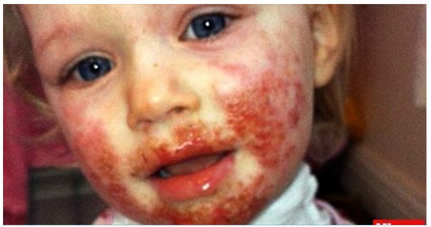 BACIO DA UNA PARENTE: BIMBA DI 3 ANNI MANGIATA DALL'HERPES - 16/11/2016