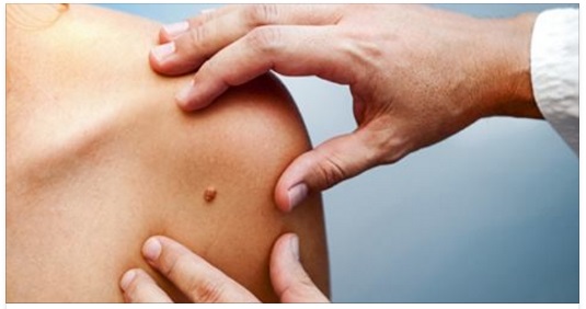 MELANOMA, INTERCETTATO IL SEGNALE CHE ANTICIPA LA FORMAZIONE MALIGNA - 30/11/2016