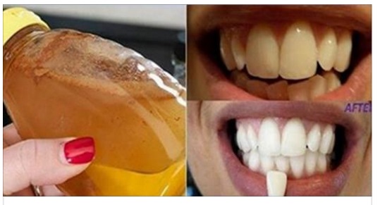 DITE ADDIO AI DENTI GIALLI CON QUESTA MERAVIGLIOSA RICETTA FATTA IN CASA - 30/11/2016