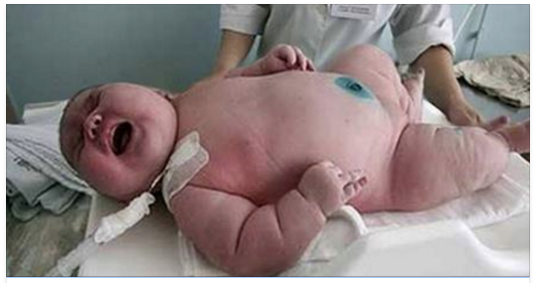 CLAMOROSO - GIOVANE DONNA HA MESSO ALLA LUCE UN BAMBINO DI 20 KG - FOTO - 12/12/2016