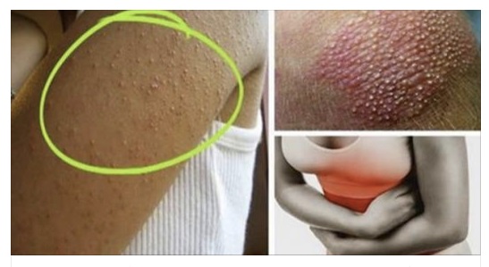 INTOLLERANZE AL GLUTINE: SEGNI E SINTOMI DA NON IGNORARE PER UNA DIAGNOSI PRECOCE - 12/12/2016