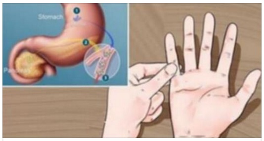 ECCO IL TEST DELLE DITA PER SAPERE IN UN SOLO MINUTO SE SEI A RISCHIO DIABETE - 19/12/2016