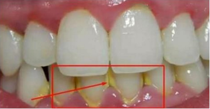 ELIMINARE LA PLACCA IN MODO NATURALE IN SOLI 5 MINUTI SENZA ANDARE DAL DENTISTA - 27/03/2017