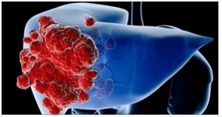 TUMORE, ORMAI E' UFFICIALE: ECCO L'ALIMENTO PIU' CANCEROGENO, LO MANGIAMO TUTTI - 21/05/2017
