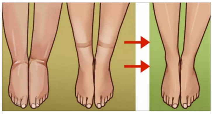 ECCO L'UNICO METODO PER RIDURRE IL GONFIORE ALLE GAMBE SE SOFFRI DI RITENZIONE IDRICA - 21/05/2017