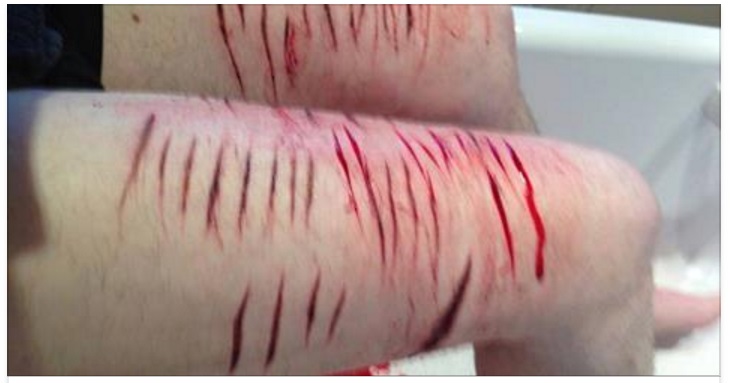 AUTOLESIONISMO TRA LE RAGAZZINE: ''SIAMO IN PIENA EMERGENZA...'' ECCO COSA STA ACCADENDO IN ITALIA - 21/05/2017