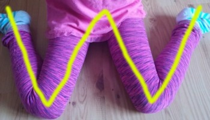 SE VEDI BAMBINI SEDUTI CON LE GAMBE A ''W'' FALLI ALZARE SUBITO. ECCO PERCHE' - 05/06/2017