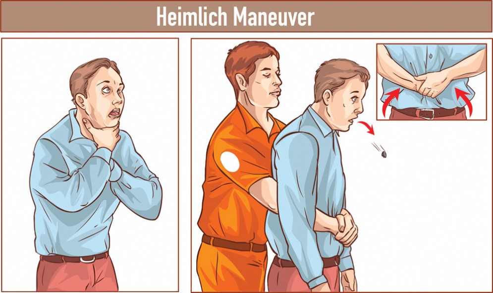 LA MANOVRA DI HEIMLICH: QUESTO IL NOME CHE TI POTREBBE SALVARE LA VITA IN CASO DI SOFFOCAMENTO - 17/07/2017