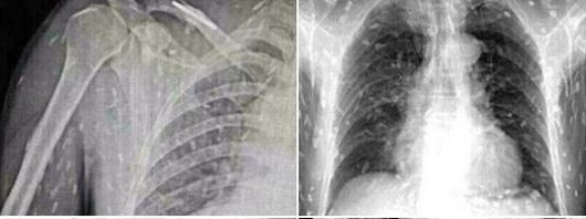 IL SUSHI FA MALE. ECCO COS'E' SUCCESSO A QUEST'UOMO, IL CORPO INVASO DAI VERMI - 16/01/2015