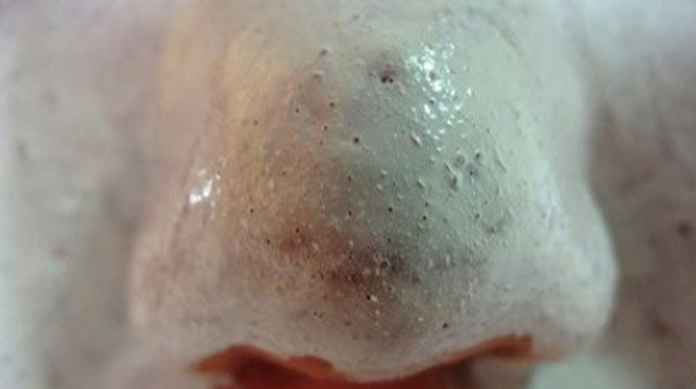 ECCO COME ELIMINARE DEFINITIVAMENTE I PUNTI NERI IN MODO NATURALE - VIDEO - 26/06/2015