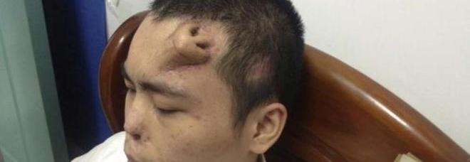 PERDE IL NASO IN UN INCIDENTE: I MEDICI GLIELO FANNO RICRESCERE IN FRONTE - VIDEO - 25/09/2013