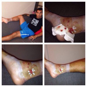 Tevez shock: mi hanno quasi rotto la caviglia! E mostra le foto del piede malconcio - Foto all'interno - 28/09/2013