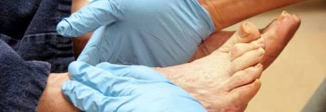 AMPUTANO UNA GAMBA A UN DIABETICO MA È QUELLA SBAGLIATA - 06/10/2013