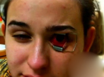 Lenti a contatto sporche! Ragazza rischia la cecità a causa di un parassita ''mangia cornea'' - 08/11/2013