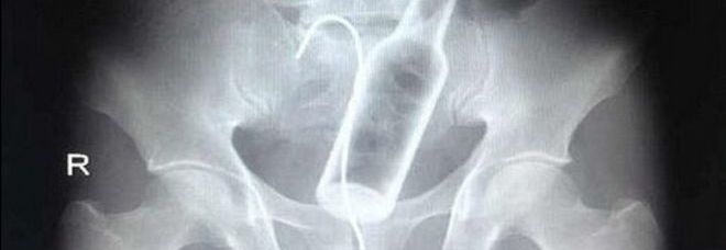 HA UNA BOTTIGLIA INCASTRATA NELL'ADDOME, AI MEDICI: ''NON SO COME POSSA ESSERCI FINITA'' - 11/01/2014