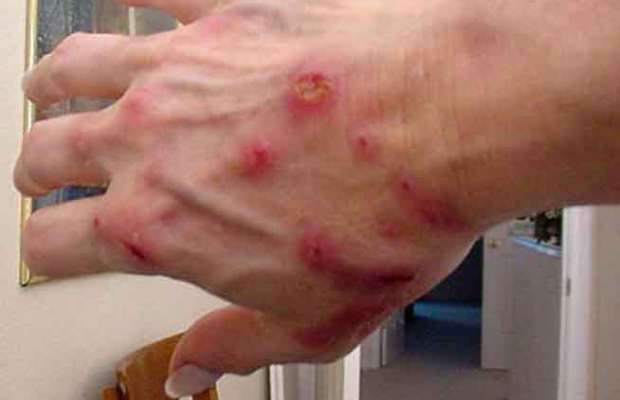 LA SINDROME DI MORGELLONS, LA MALATTIA CHE METTE PAURA A TUTTO IL MONDO - 18/01/2014