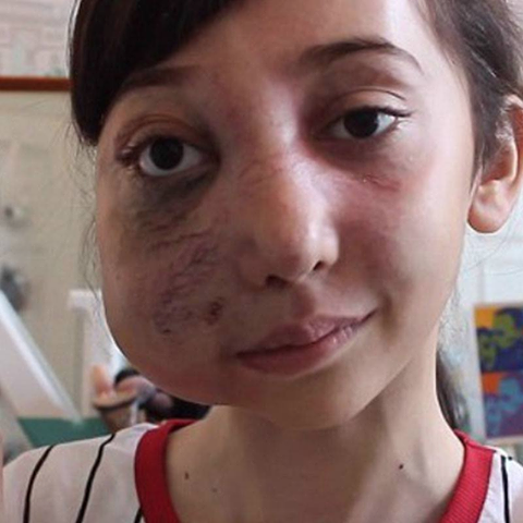 HA SOLO 11 ANNI MA IL SUO ASPETTO E' DIVERSO DALLE SUE COETANEE: QUELLO CHE LE E' ACCADUTO E' TERRIBILE - 13/03/2016
