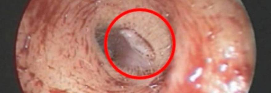 VA DAL MEDICO PER IL MAL D'ORECCHI: SCOPRE CHE DENTRO VIVE UN VERME - VIDEO - 14/02/2014