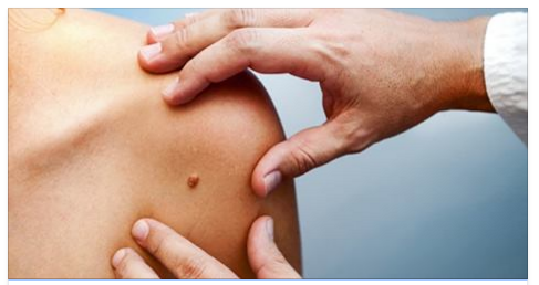 MELANOMA, INTERCETTATO IL SEGNALE CHE ANTICIPA LA FORMAZIONE MALIGNA - 06/05/2016