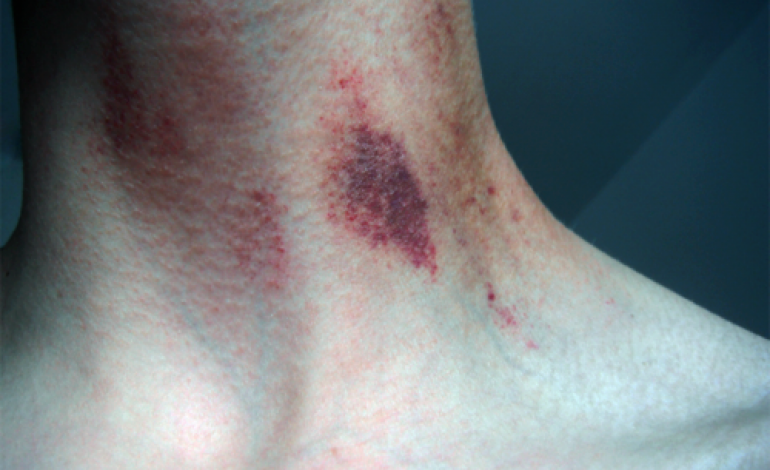 LEI COMINCIA A SUCCHIARE E LUI ALLA FINE MUORE: ECCO COS'E' SUCCESSO A UN RAGAZZO - 27/12/2016