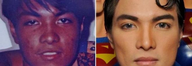 VUOLE DIVENTARE COME SUPERMAN: IN 19 ANNI, 19 OPERAZIONI CHIRURGICHE - FOTO - 11/04/2014