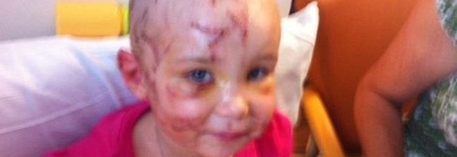 PITBULL AZZANNA LA BIMBA DI 2 ANNI: LA MAMMA LE SALVA LA VITA MORDENDOGLI L'ORECCHIO - 22/04/2014