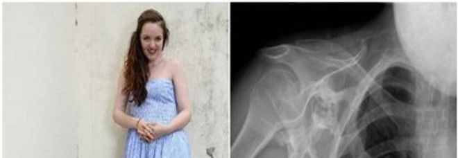A 18 ANNI STA DIVENTANDO UNA STATUA: ''UN SECONDO SCHELETRO CRESCE IN ME'' - 23/05/2014