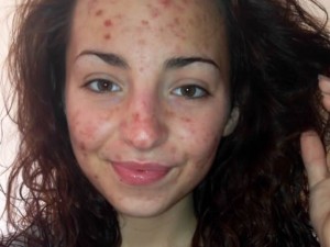 IL RARISSIMO DISTURBO PSICOLOGICO DI SAMANTHA A SOLI 20ANNI - FOTO - 17/07/2014