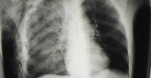 TUMORI IN CRESCITA COME UN'EPIDEMIA. I PIÙ PERICOLOSI SECONDO L'OMS - 09/11/2014