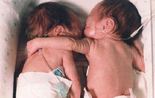 HA ABBRACCIATO SUA SORELLA MALATA: QUELLO CHE SUCCEDE DOPO NESSUNO POTEVA ASPETTARSELO - FOTO - 04/05/2015