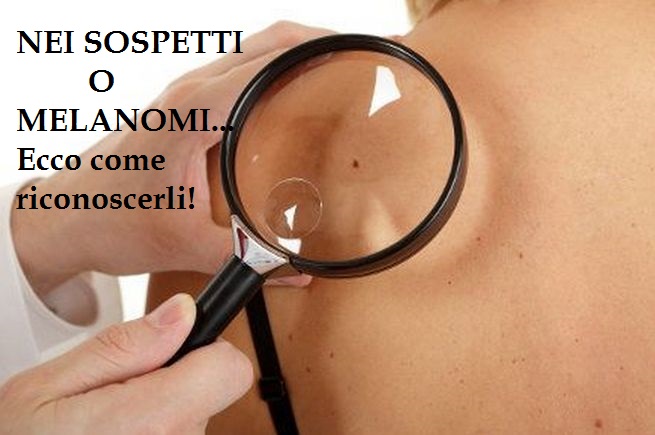 ECCO COME RICONOSCERE I ''NEI'' MALIGNI SULLA NOSTRA PELLE: MAI SOTTOVALUTARLI - 28/05/2015