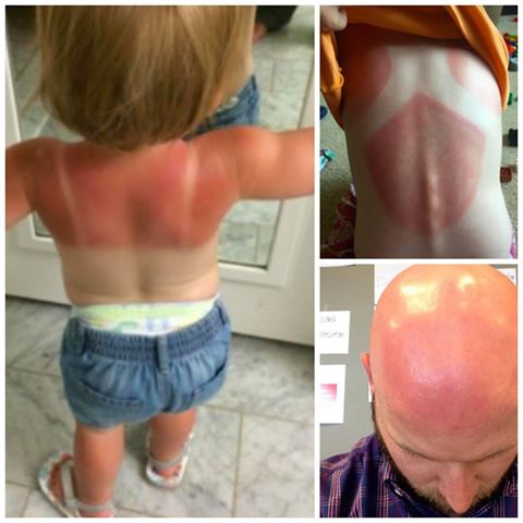''NON USATE QUESTA CREMA SOLARE'' BOOM DI BAMBINI E ADULTI USTIONATI E L'ALLARME SI DIFFONDE SUL WEB - 08/07/2016