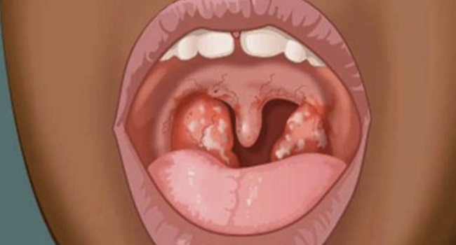 COME ELIMINARE IL MAL DI GOLA IN POCHE ORE SENZA L'USO DEI MEDICINALI: ECCO I 5 POTENTI RIMEDI NATURALI - 06/12/2016