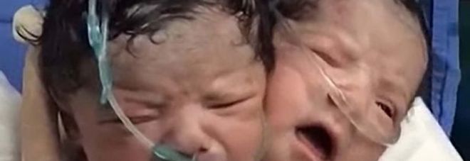 BIMBO NASCE CON DUE TESTE: MEDICI STUPITI. I PARENTI POSTANO LE IMMAGINI SUI SOCIAL - 10/01/2017