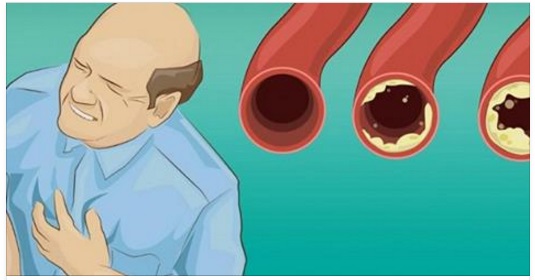 QUESTI 20 CIBI PULISCONO NATURALMENTE LE ARTERIE E PREVENGONO GLI INFARTI: ECCO COME VIVERE PIU' A LUNGO - 23/01/2017