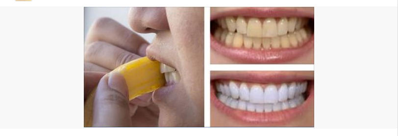LA BUCCIA DI BANANA PER SBIANCARE I DENTI: ECCO COME FARE - 20/06/2016