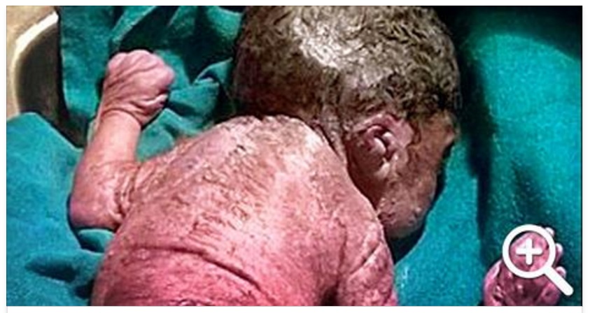 BIMBO NASCE CON 'SINDROME DELLA SIRENA' E MUORE DOPO 10 MINUTI - FOTO - 03/05/2016